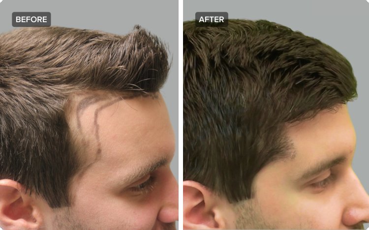 Choosing Excellence: A Comprehensive Guide to the Best Hair Transplant in Islamabad