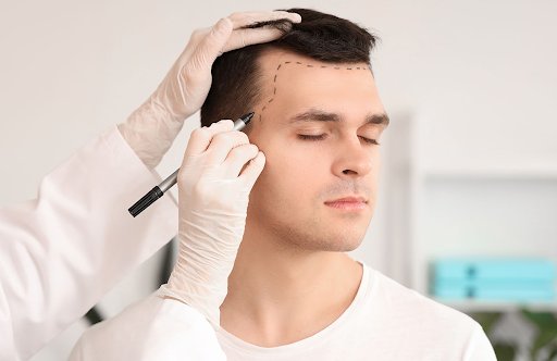 What to Expect from a Hair Transplant Clinic in London