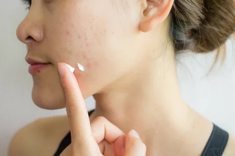 The Best Acne Program in Tustin: Where to Start for Clear Skin