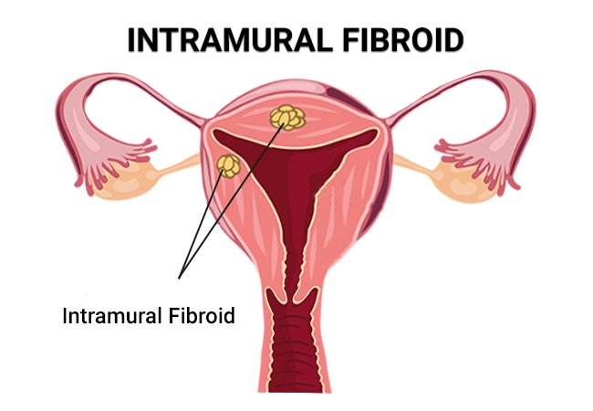 Exploring Intramural Fibroids: Causes, Symptoms, and Treatment